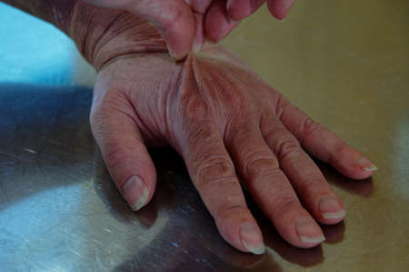 Pinching the back of a hand to test for dehydration on a stainless steel benchの写真素材