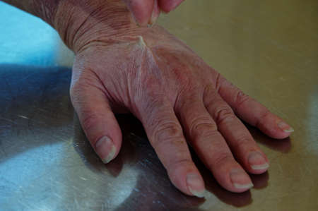 The turgor test for dehyrdation, a sking tent is left after the pinch has been releasedの写真素材