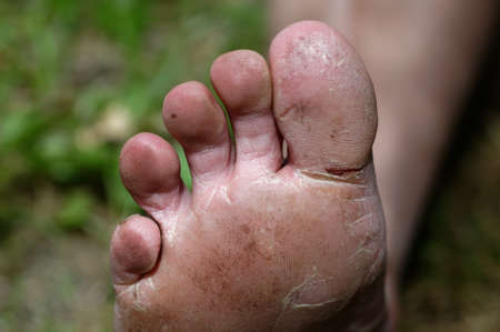 The big toe on this foot has a nasty crack under it where the skin is dry and has split.の写真素材