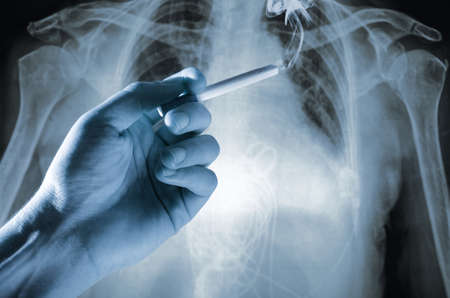 Hand with a cigarette in front of the x ray image of human abdomenの写真素材