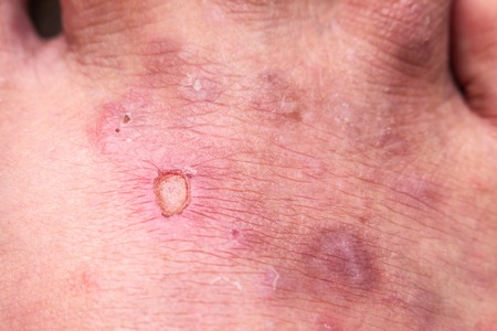 closeup skin athleteâ€™s foot psoriasis fungus, hong kong foot, foot disease