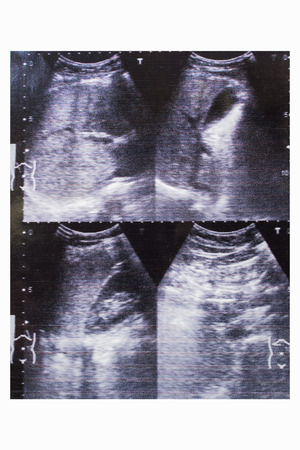 ultrasound picture printed of gallbladder, liver inflammation of female