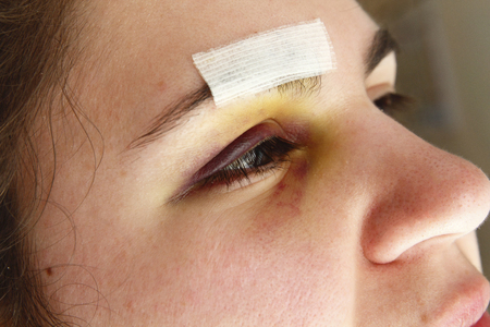 Woman with black after an accident or injuredの写真素材