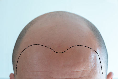 View of bald man's head with hair lossの写真素材