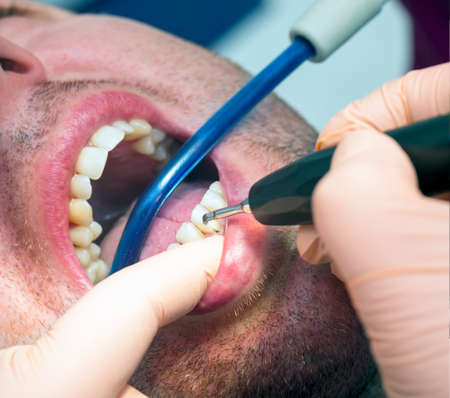 Dentist making patient's teeth hygiene  in a clinicの写真素材
