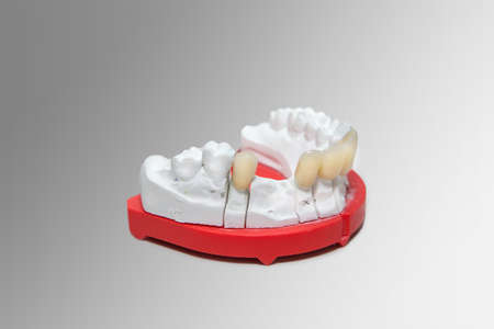 Gypsum dental model with ceramic teeth on a grey gradient background