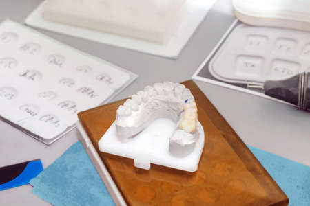 Gypsum dental model with ceramic teeth on a dentistâs tableの写真素材
