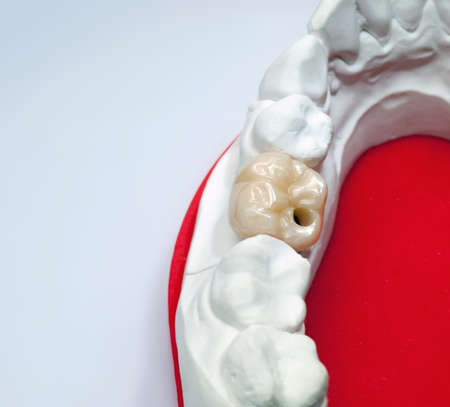 Gypsum dental model with ceramic tooth on a white  background