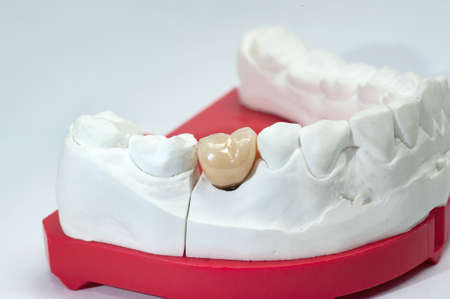 Gypsum dental model with ceramic tooth on a white background