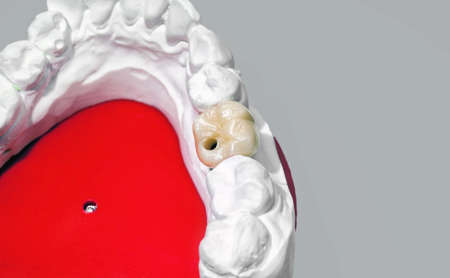Gypsum dental model with ceramic tooth on a grey  backgroundの写真素材