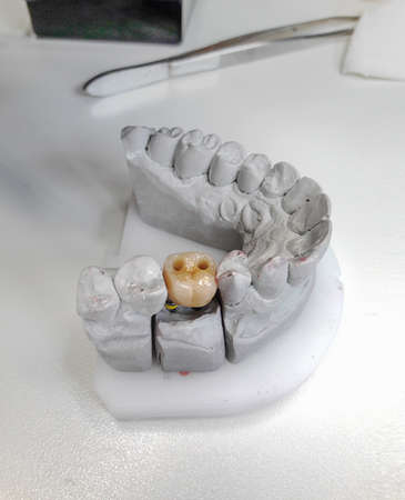 Gypsum dental model with ceramic tooth on a dentist table 