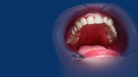 Mouth with bleeding gums on a blue background. Close up.