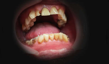 Mouth  with caries damaged teeth on a dark background. Close up.