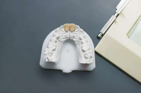 Gypsum dental model with ceramic teeth on a  grey tableの写真素材