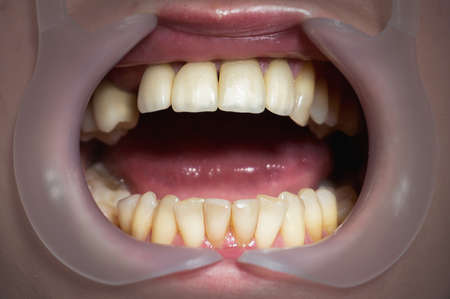 Mouth with four prosthetic upper teeth. Close up.の写真素材