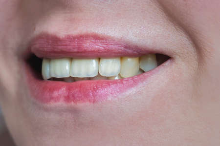 Mouth with four prosthetic upper teeth. Close up.の写真素材