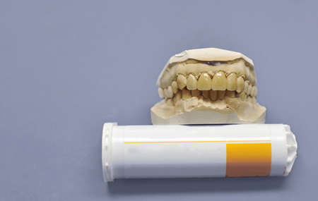 Gypsum dental model with four ceramic teeth  on a  dentist tableの写真素材