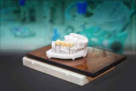 Technical shots of gypsum model with ceramic teeth on a dental prothetic laboratory の写真素材