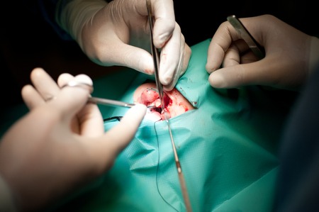 Siberia, Russia - September 10, 2012: Plastic surgery on moith lip and nouse