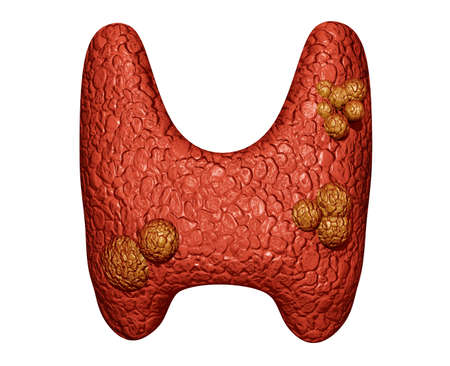 Close-up Thyroid cancer. development of cancer in the thyroid gland. isolated illustration on white...