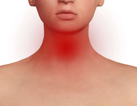 Thyroid gland exposed on the neck of a woman with endocrine disruption, inflammation and swelling....