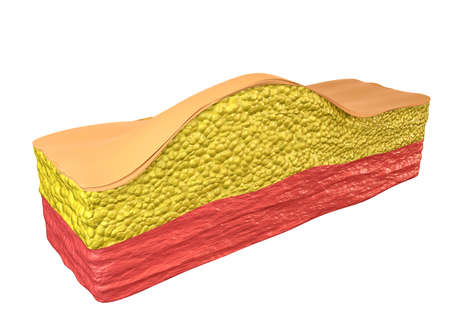Lipoma - a benign tumor composed of adipose tissue cells (adipocytes), which accumulate inside a fibrous capsule just below the skin in the subcutaneous tissue. 3D illustrationの写真素材