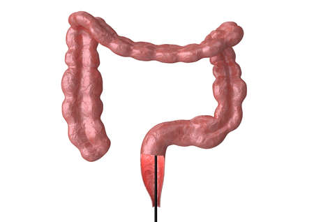 colonoscopy - is the endoscopic examination of the large intestine and rectum that helps in the...