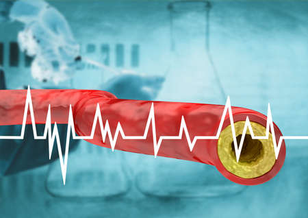graph with cholesterol test in patient, result with vein and artery with accumulation of fats. 3D illustrationの写真素材