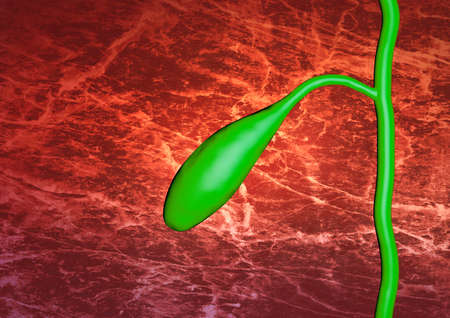 enlarged gallbladder in clinical examination for stones and diseases. 3D renderingの写真素材