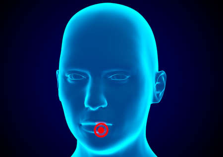 Cold sores are a herpes simplex virus infection that causes blisters or sores in the mouth, usually...