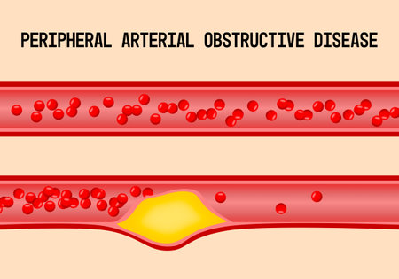 Peripheral arterial occlusive disease is the narrowing or blockage of an artery in the legs, usually due to atherosclerosis. medical illustrationの写真素材