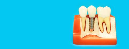 medical model of the jaw with false teeth on a pin on a blue background