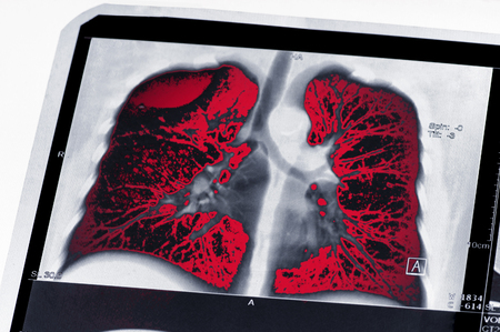 Tumor. Lung cancer. The MRI highlighted in red tumor. The effects of Smokingの写真素材