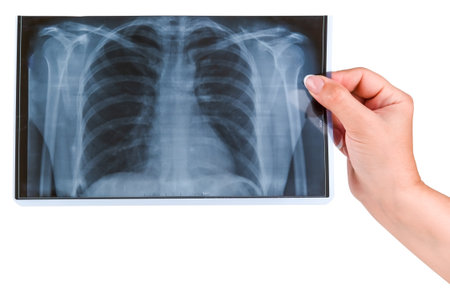 in a female hand x-ray of the lungs isolated on a white background.
