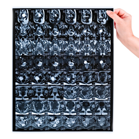 Female hand holding MRI scan of pelvis isolated on white background.