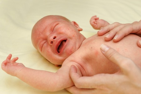 sick newborn child with alergy rash cries for painの写真素材
