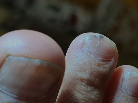 Closeup of a foot with damaged nails because of fungus. Dorsal, callus and corn feet infected by...