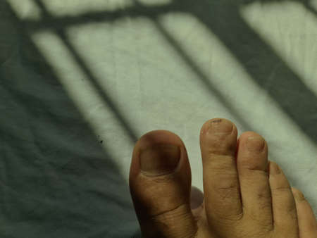 Closeup of a foot with damaged nails because of fungus. Dorsal, callus and corn feet infected by...