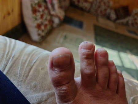 Closeup of a foot with damaged nails because of fungus. Dorsal, callus and corn feet infected by germs that cause nail dislocations.の写真素材