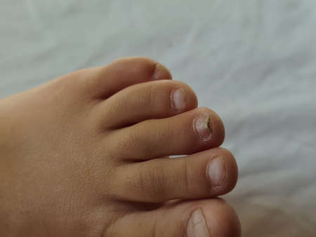 Closeup of a foot with damaged nails because of fungus. Dorsal, callus and corn feet infected by germs that cause nail dislocations.の写真素材