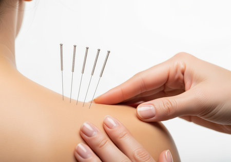 Close up shot showing a professional applying several sterile acupuncture needles into a patient shoulder. this traditional chinese medicine therapy is used for pain management, stress relief, and holistic wellness.の素材