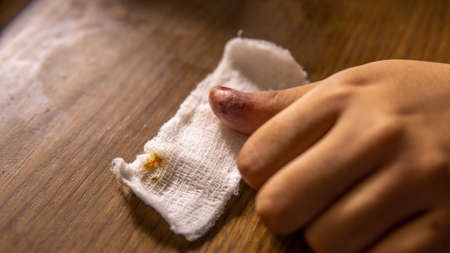 An infection wound with pus inside the thumb on the white bandage with blood stains. Causing from friction to phone touchscreen of playing to many mobile games.の写真素材