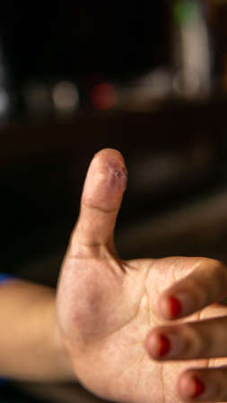 An infection wound with pus inside the thumb. Causing from friction to phone touchscreen of playing...