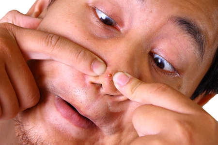 Asian man squeezing acne on his nose with two fingers