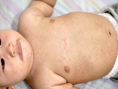 Little Asian baby girl with red rash on her skin, measles or chicken pox on newborn