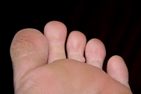 Close up of cracked dry skin on toe foot, dermal health and disease conceptの写真素材