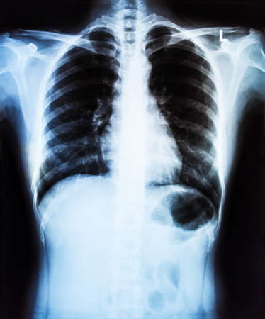 X-Ray Image Of Human Chest for a medical diagnosisの写真素材