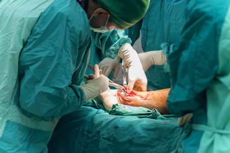 Selective focus hand of Orthopedic doctor during surgery use instruments fixation inside leg of patient in operating room at hospital.  Case fracture patient from an accident.の写真素材