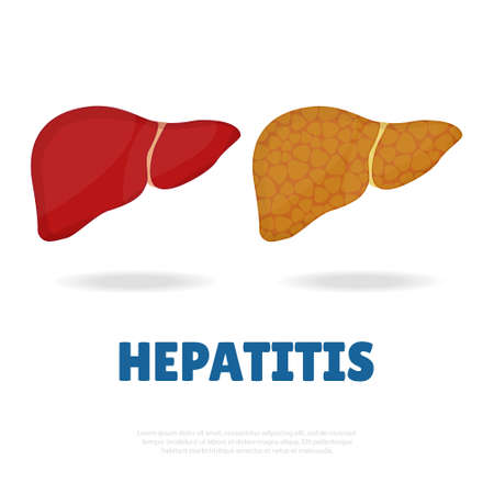 Vector Illustration on the theme of Hepatitis. Healthy and sick liver.のイラスト素材