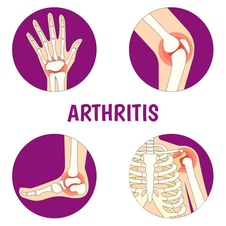 Vector Illustration on the theme World Arthritis Dayのイラスト素材